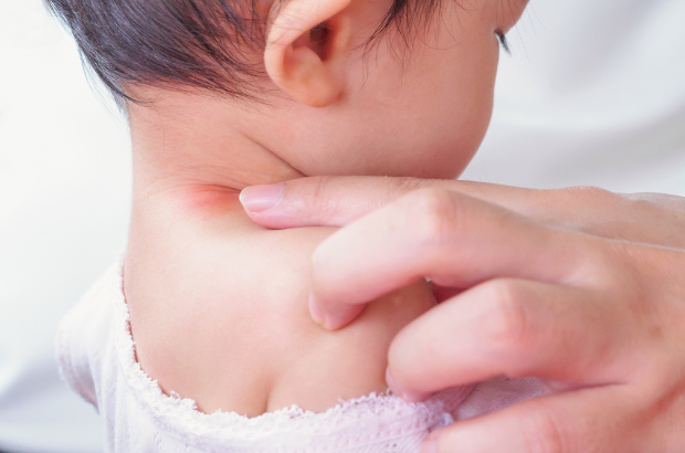 15 Cara Menghilangkan Bekas Gigitan Nyamuk Pada Bayi, Terbukti Efektif