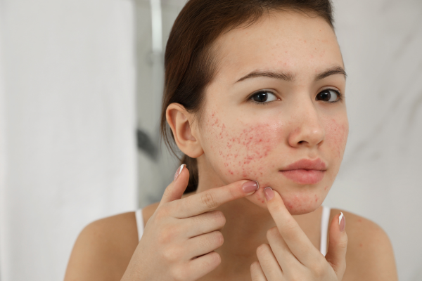 Kenali 5 Ciri-Ciri Kulit Wajah Iritasi Karena Skincare dan Cara Mencegahnya?