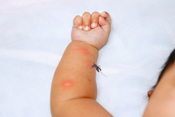 5 Cara Alami Menghilangkan Bekas Gigitan Nyamuk Pada Bayi