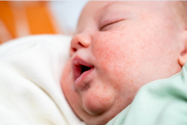 5 Cara Menghilangkan Biang Keringat di Wajah Bayi, Tebukti Efektif
