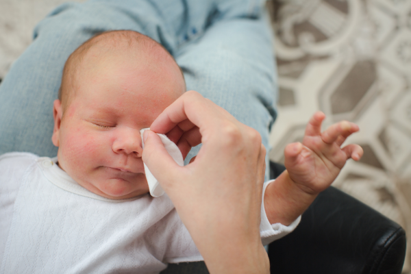 Cara Menghilangkan Biang Keringat di Wajah Bayi
