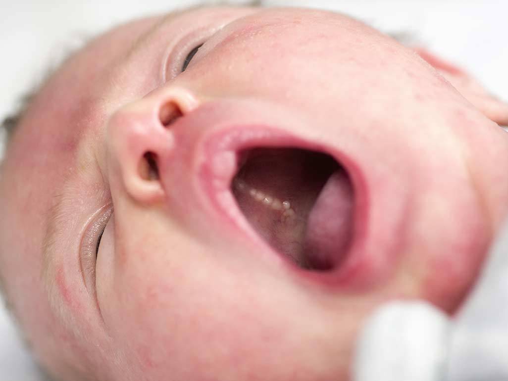 Hindari 5 Penyebab Infeksi Jamur Pada Mulut Bayi, Kenali Sedari Dini!