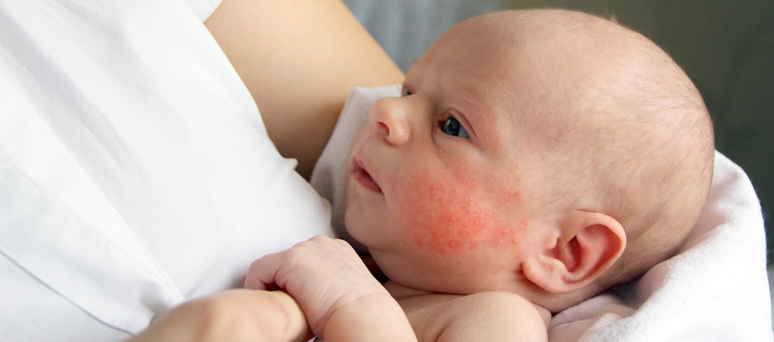 Ciri-Ciri Infeksi Jamur pada Kulit Bayi