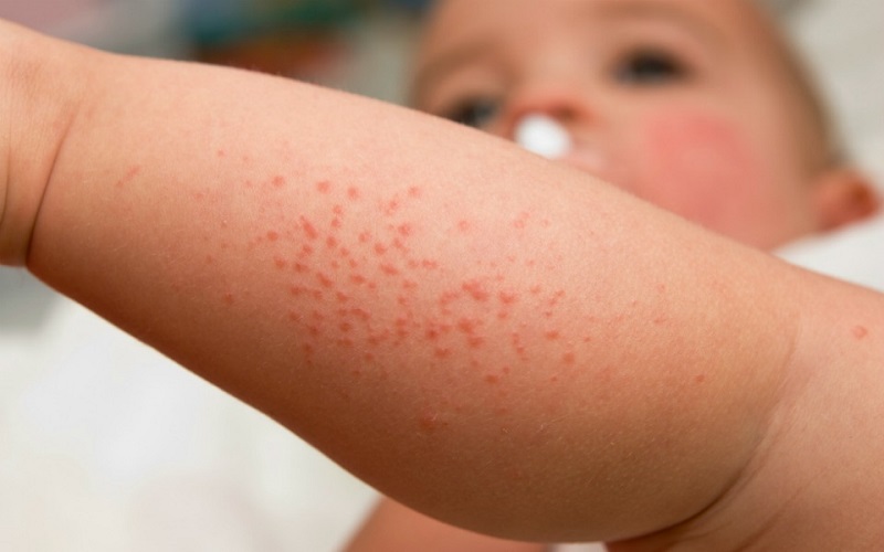 5 Ciri-Ciri Infeksi Jamur pada Kulit Bayi Sejak Dini dan Langkah Pencegahannya