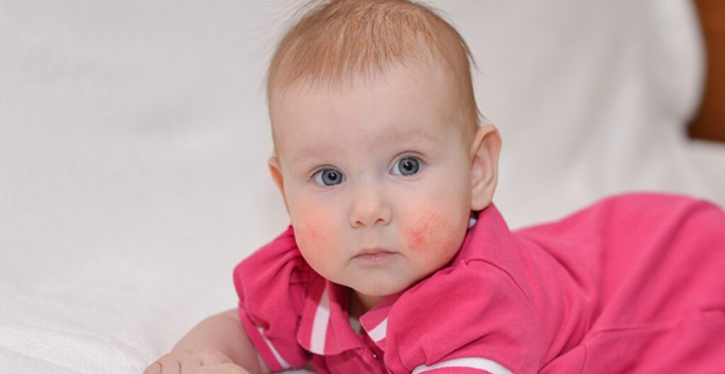 cara menghilangkan bintik merah di wajah bayi secara alami