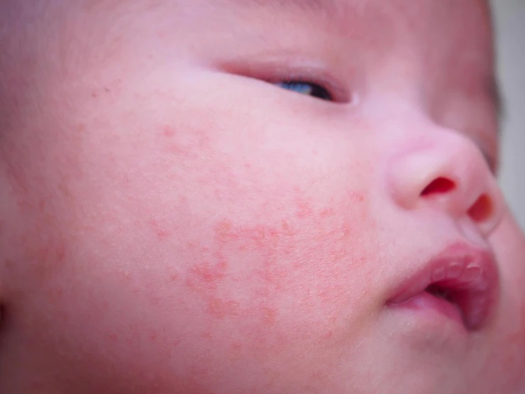 cara menghilangkan bintik merah di wajah bayi secara alami