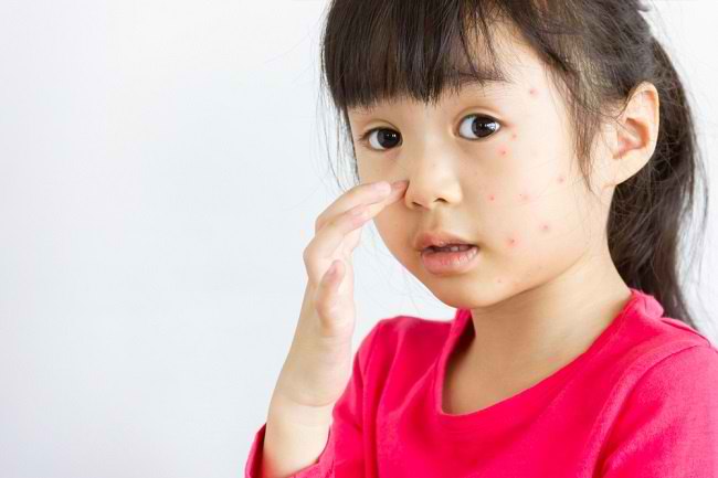 berapa lama reaksi alergi pada anak akan hilang