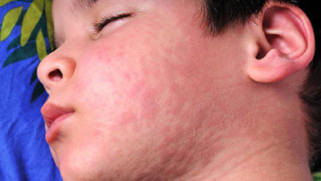 apa ciri ciri anak alergi