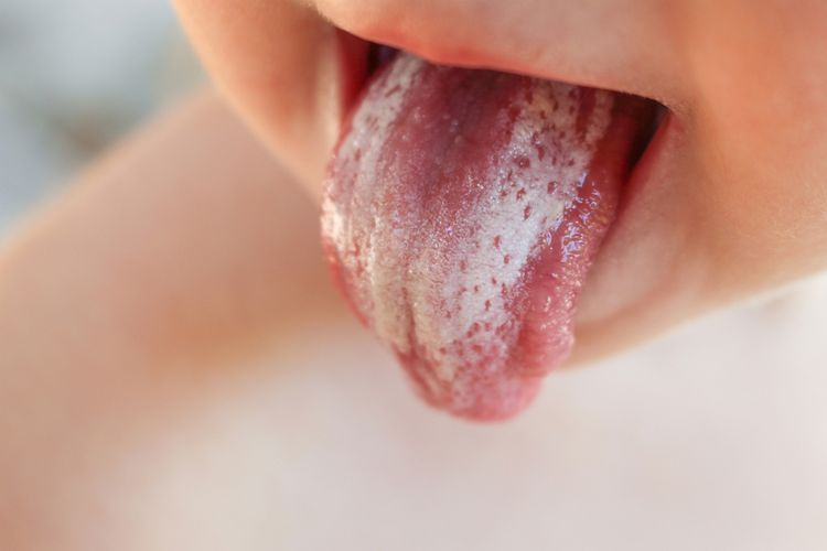 cara membersihkan lidah bayi yang putih tebal