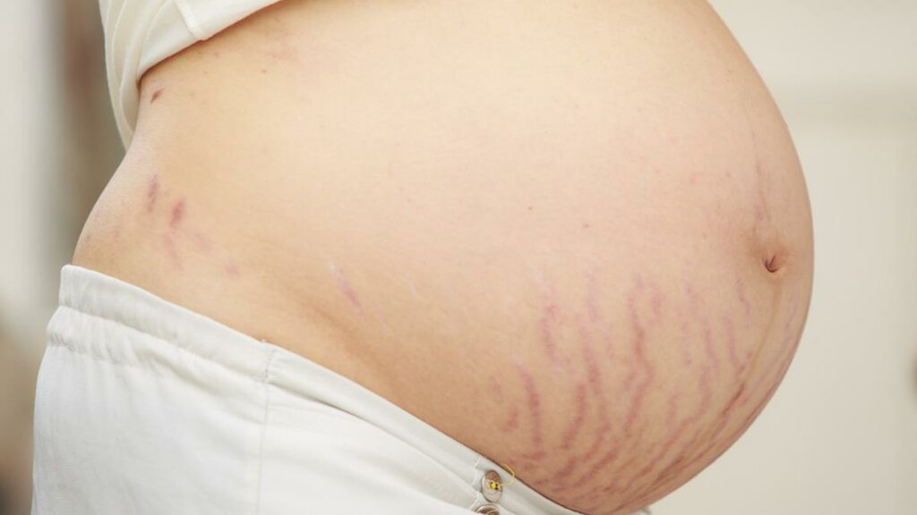 masalah kulit saat hamil