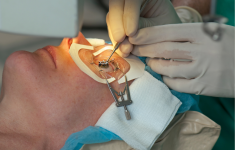 LASIK Mata