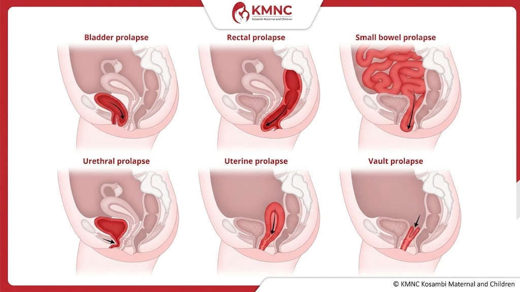 Kenali Turun Peranakan Setelah Melahirkan, Pilihan Klinik dan Dokter Uroginekologi di Jakarta Selatan 2 Anatomi Penopang